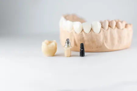 Dental Implants treatment at Rahman & Rahman Packages Mall, Lahore