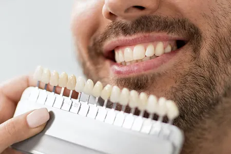 Dental Veneers treatment at Rahman & Rahman Packages Mall, Lahore