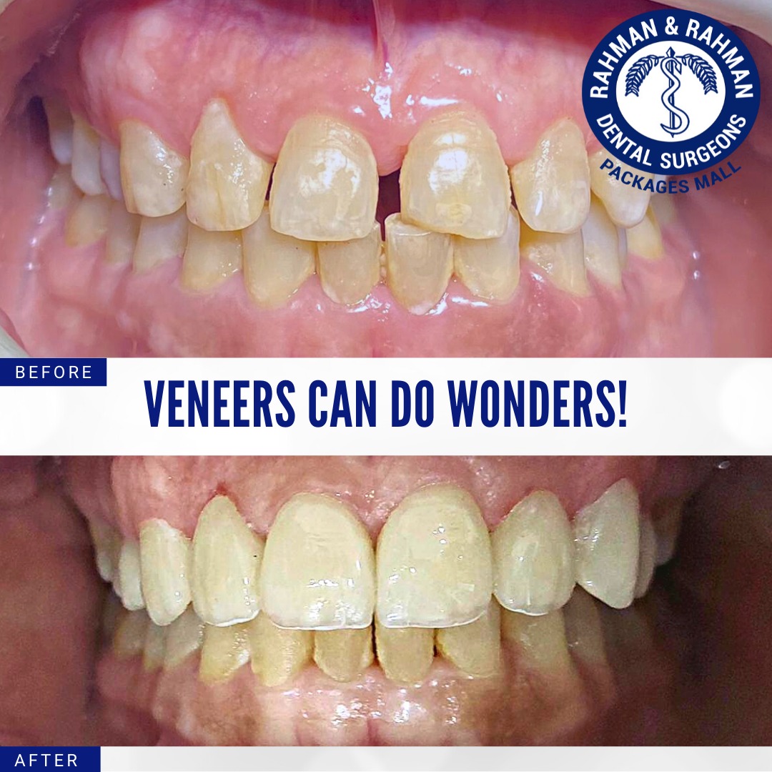 Veneers Can Do Wonders