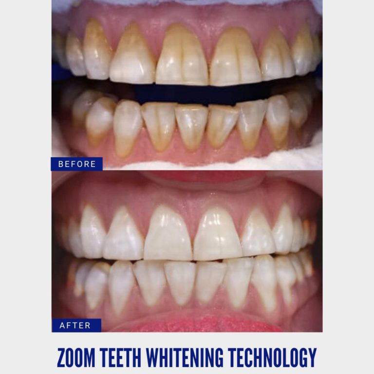 Zoom Teeth Whitening Technology
