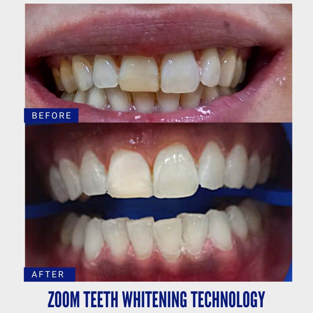 Zoom Teeth Whitening Technology
