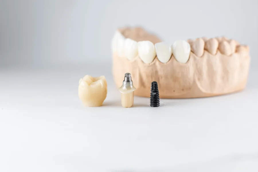 Dental implant, abutment and crown shown next to a model of teeth