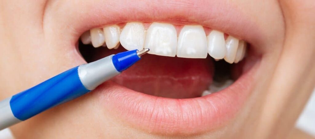 white spots on teeth