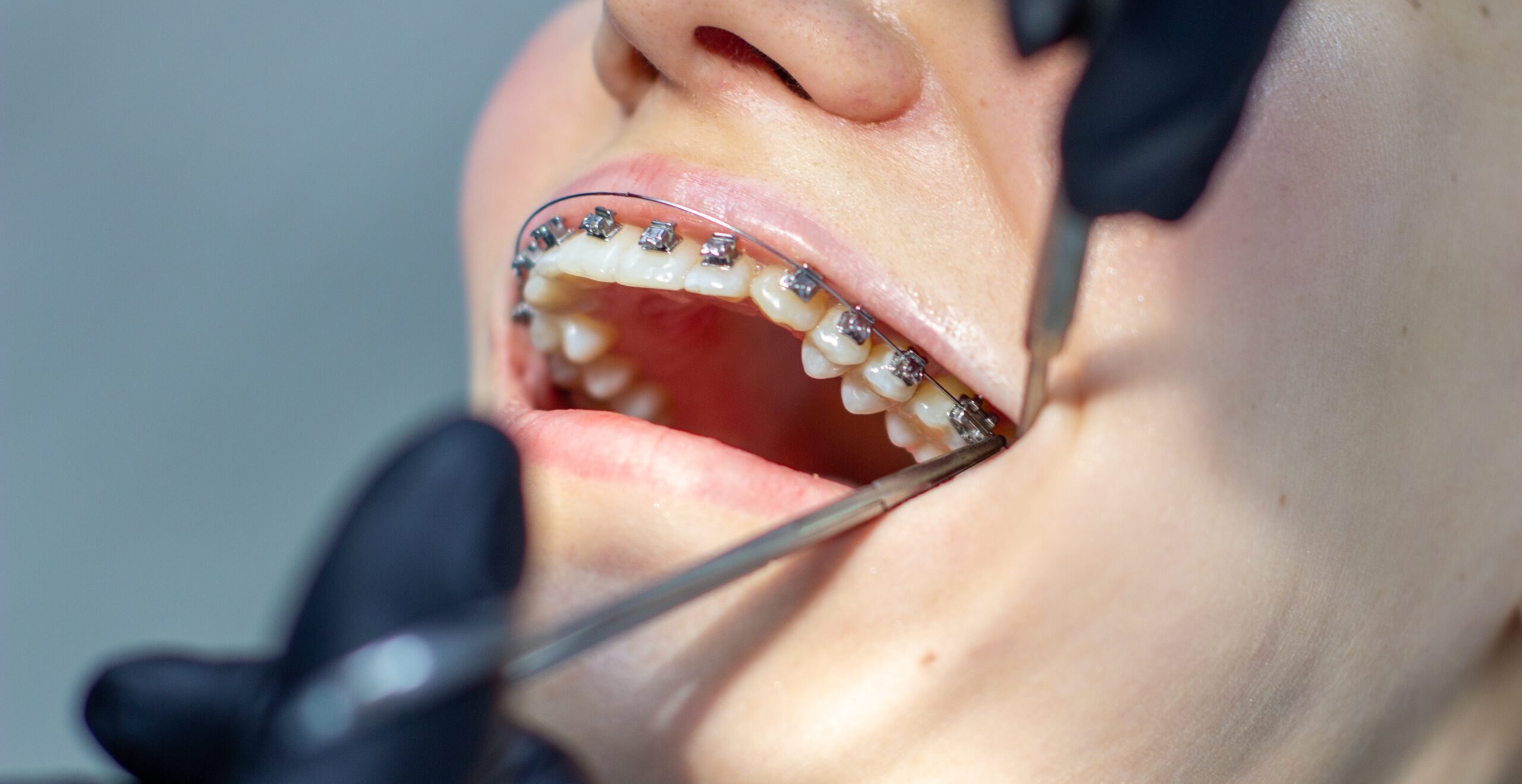 A woman at a dentist's appointment to replace arches with braces.