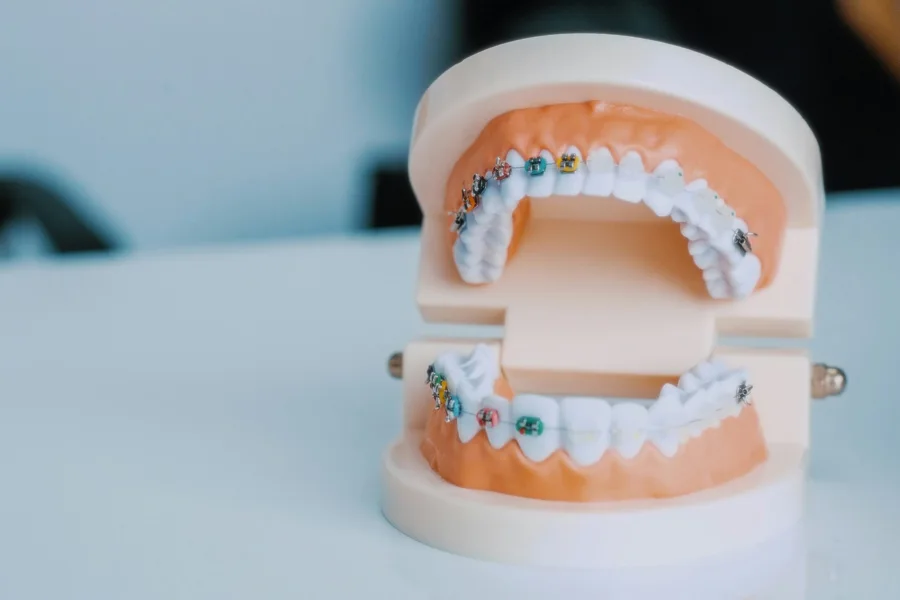 Dental model showing braces on the upper and lower teeth