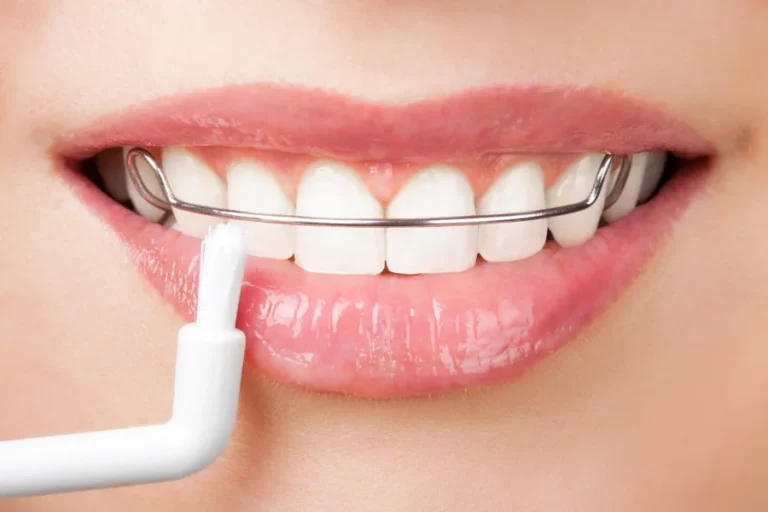 Smile with a retainer being cleaned with a small brush