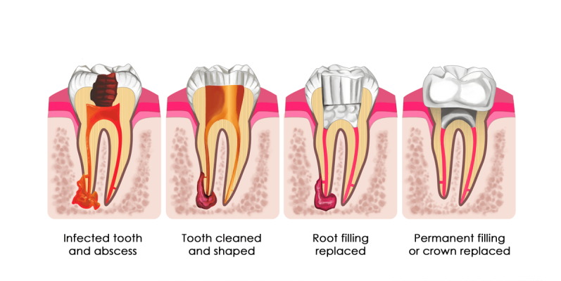 Root Canal Treatment(1)